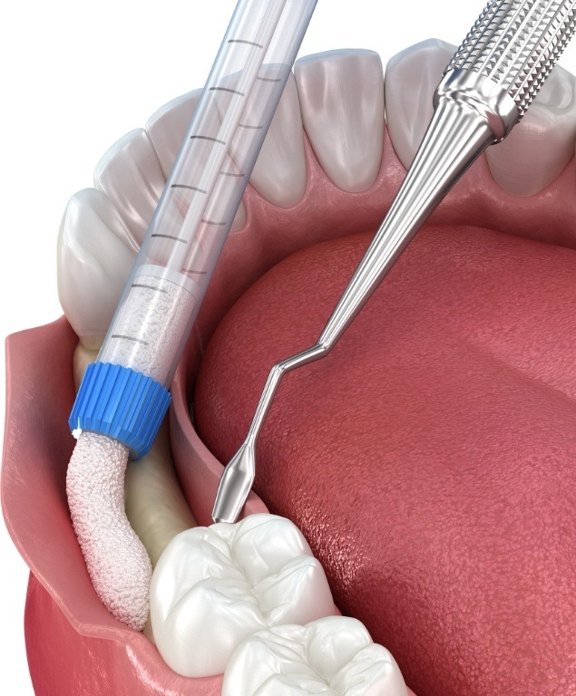 Illustrated bone grafting material being added to lower jawbone