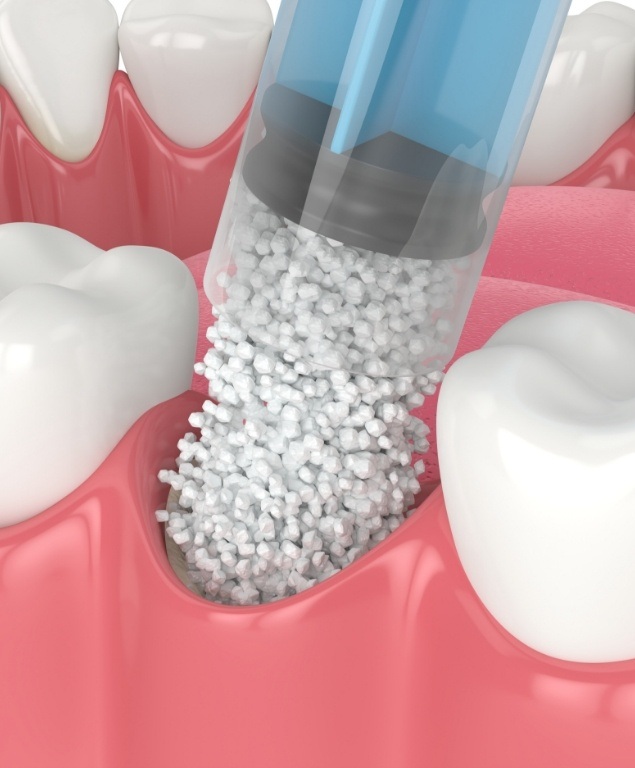 Close up of illustrated dental bone graft