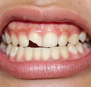 Close up of smile with chipped tooth