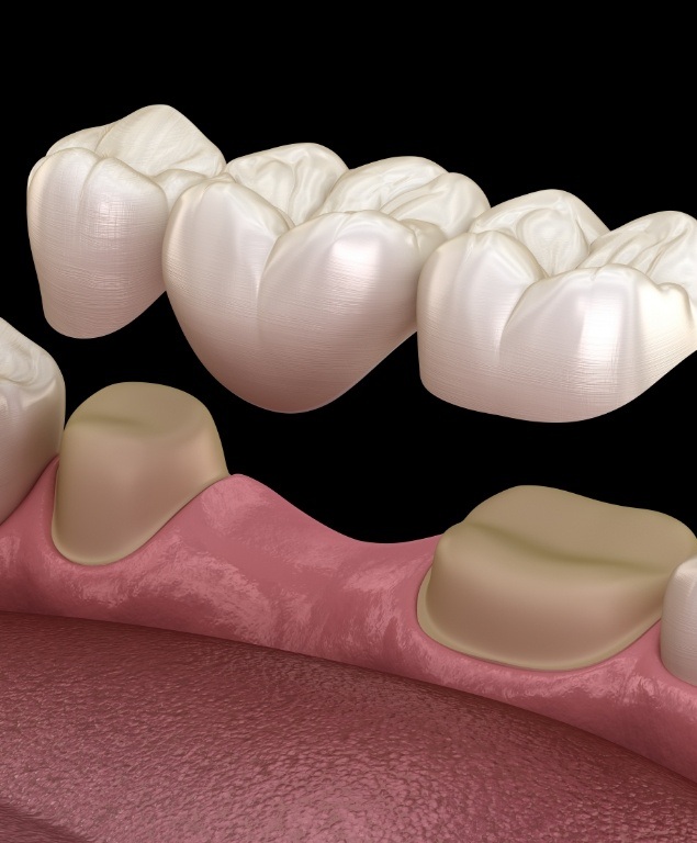 Illustrated dental bridge in Cambridge replacing a missing tooth