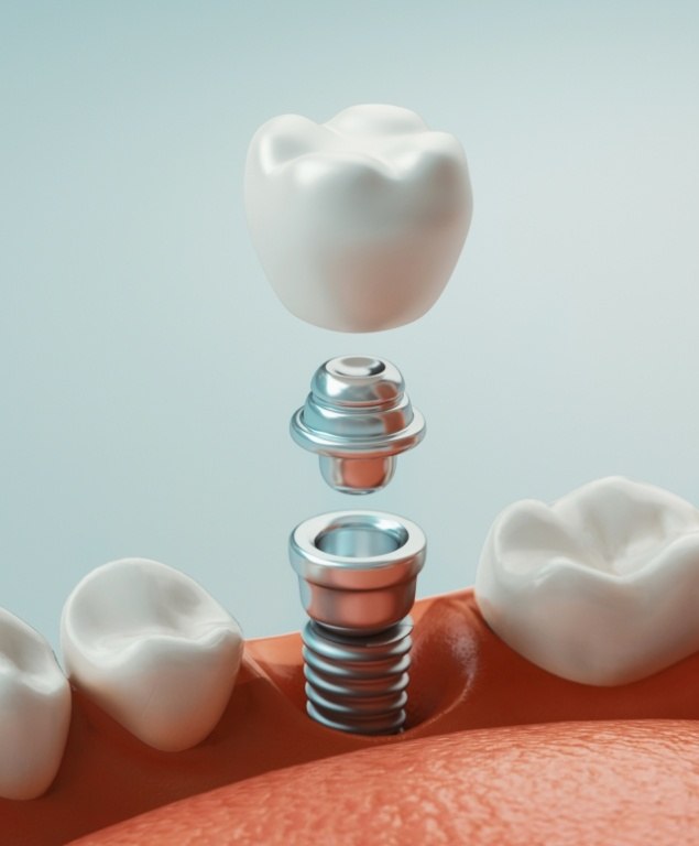 Illustrated model of a dental implant in Cambridge
