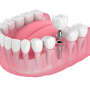 Illustration of single dental implant in lower arch