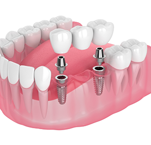 Illustration of implant bridge in lower arch