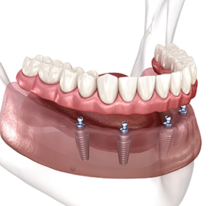 Illustration of implant dentures
