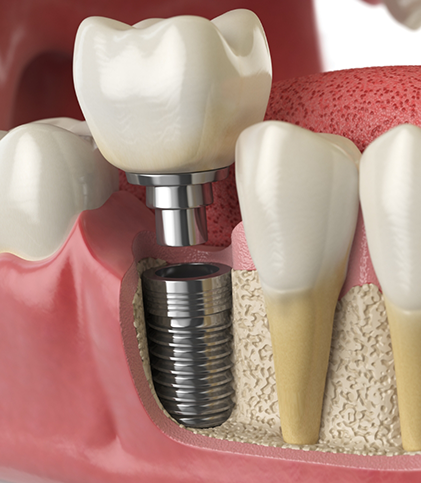 Illustration of dental crown being attached to dental implant in jaw