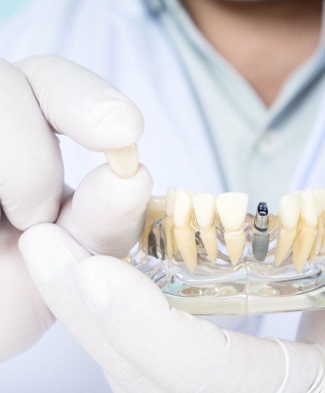Dentist holding dental crown and model of dental implant