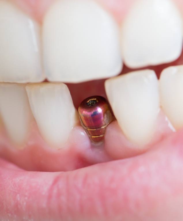 Close up of smile with visible dental implant abutment