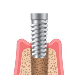 Illustration of implant post being inserted into an empty socket