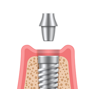 Illustration of abutment being attached to implant post