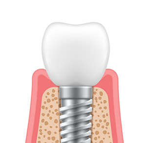 Illustration of crown attached to implant post