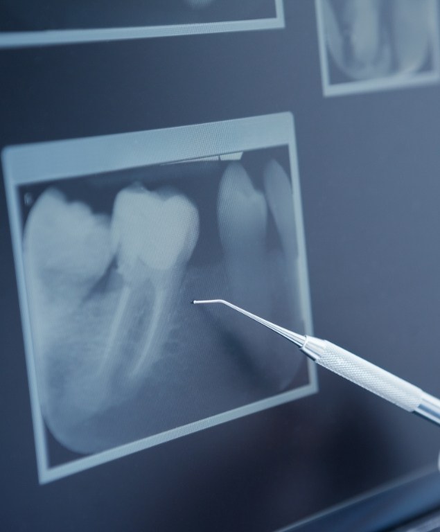 Dentist gesturing to a digital dental x ray in Cambridge