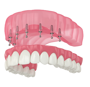 Illustration of implant denture being attached to upper arch