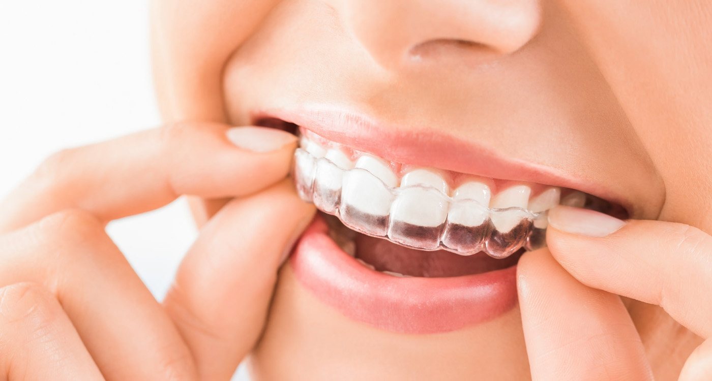 Close up of a person putting a clear aligner in their mouth