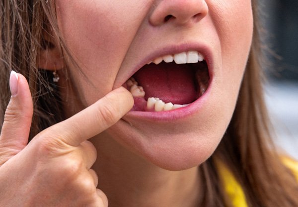 Woman missing a tooth