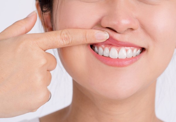 Woman pointing to her gums