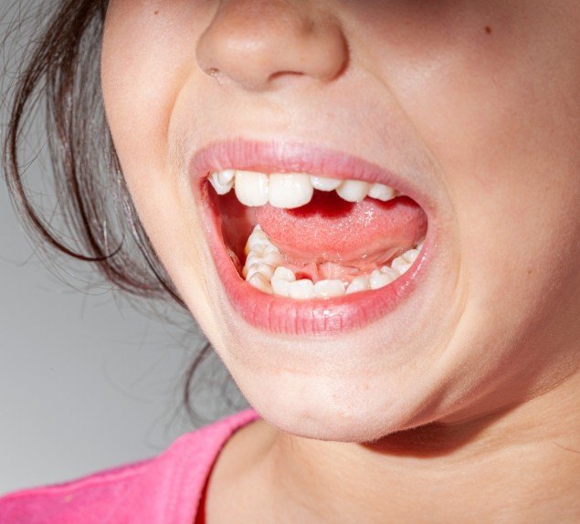Close up of child with crooked teeth
