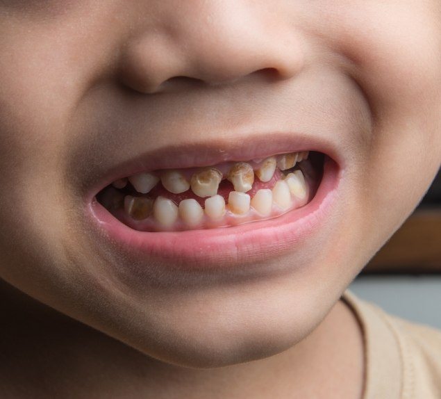Close up of child with gapped and discolored teeth