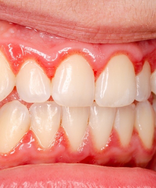 Close up of mouth with red gums