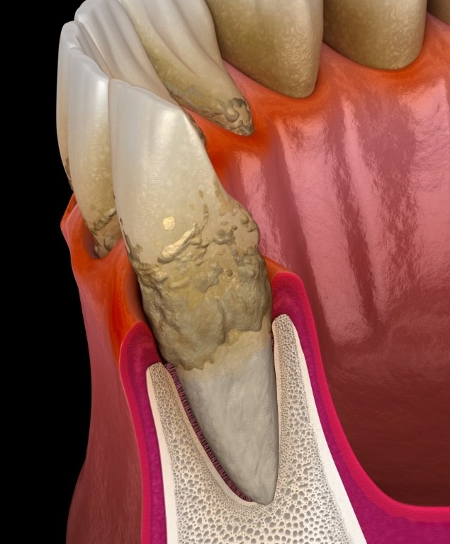 Illustrated mouth with tartar buildup from advanced gum disease