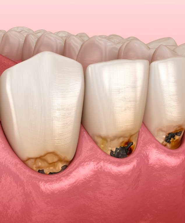 Illustrated mouth with decayed tooth roots and receding gums