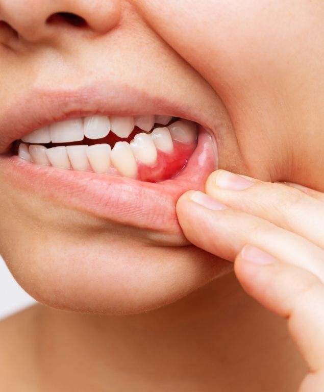 Close up of person with red spot on their gums indicating gum disease in Cambridge