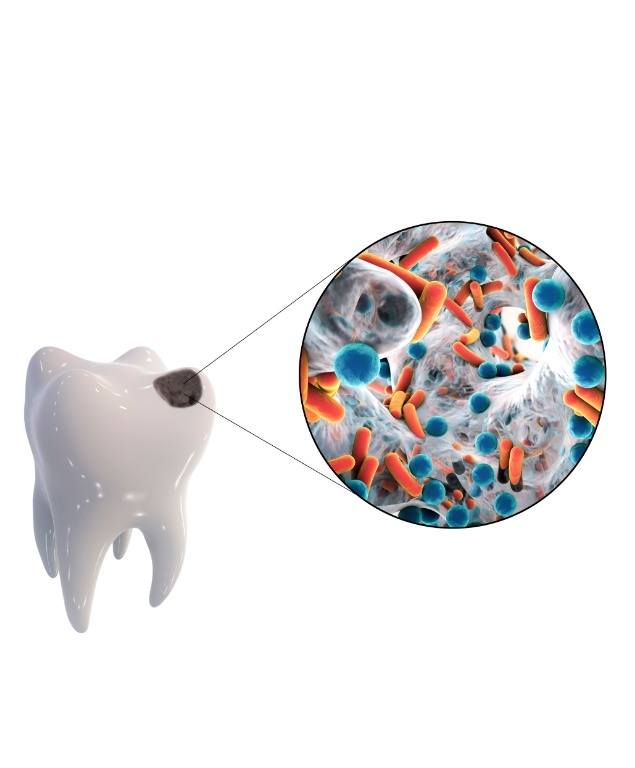 Illustrated tooth with close up showing microscopic germs causing a cavity