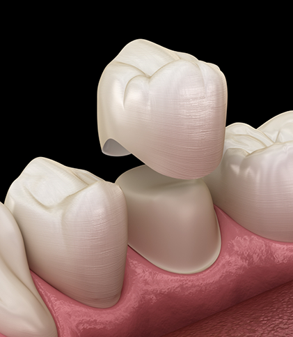 Illustration of dental crown being placed on tooth