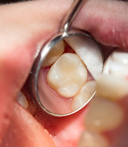 Using dental mirror to examine tooth with a filling