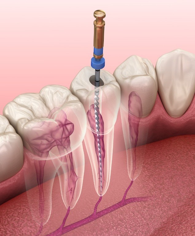 Illustrated dental instrument cleaning inside of tooth during root canal treatment