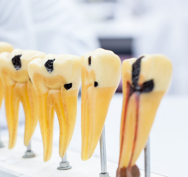 Multiple models of decayed teeth