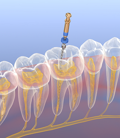 Illustration of a root canal treatment