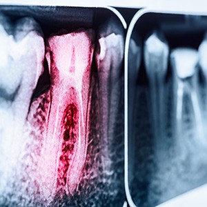 Factors that affect the cost of your root canal include the placement of the tooth within your mouth