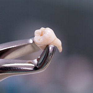 It could be cheaper to extract a tooth up front but the long term costs can often be more expensive than a root canal