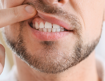 Man pulling up lip to show gums