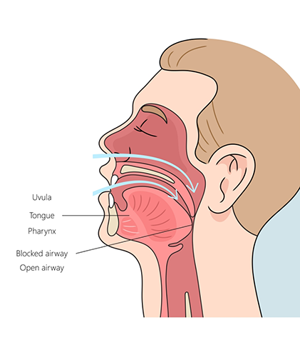 Diagram showing airway of person with sleep apnea