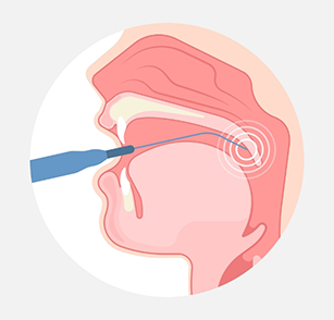 Receiving laser treatment in airway