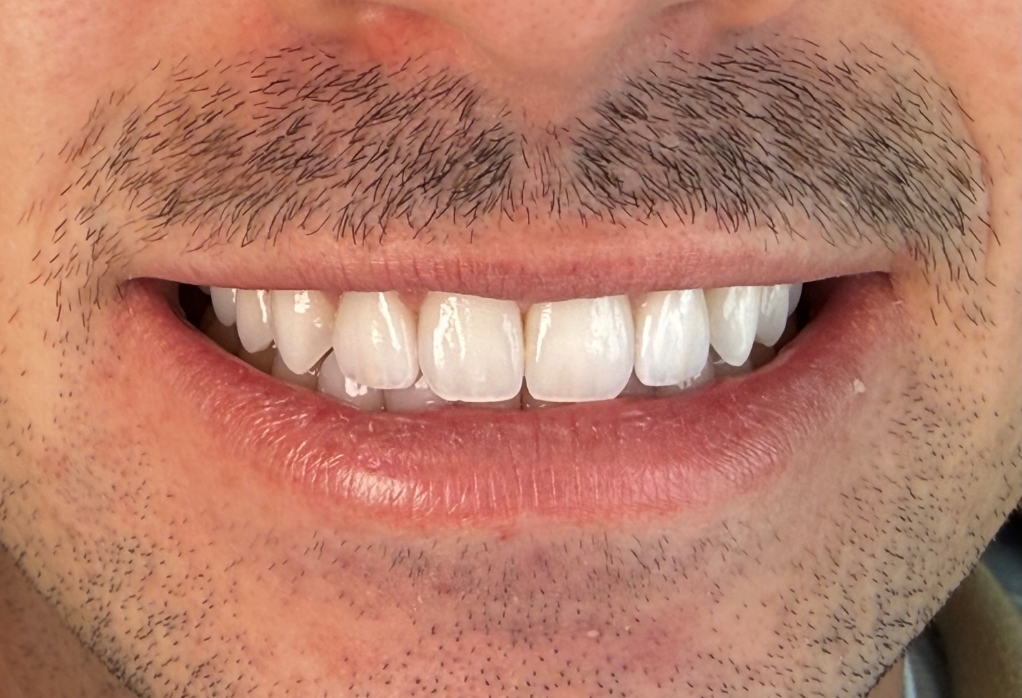 Smile with brighter looking teeth