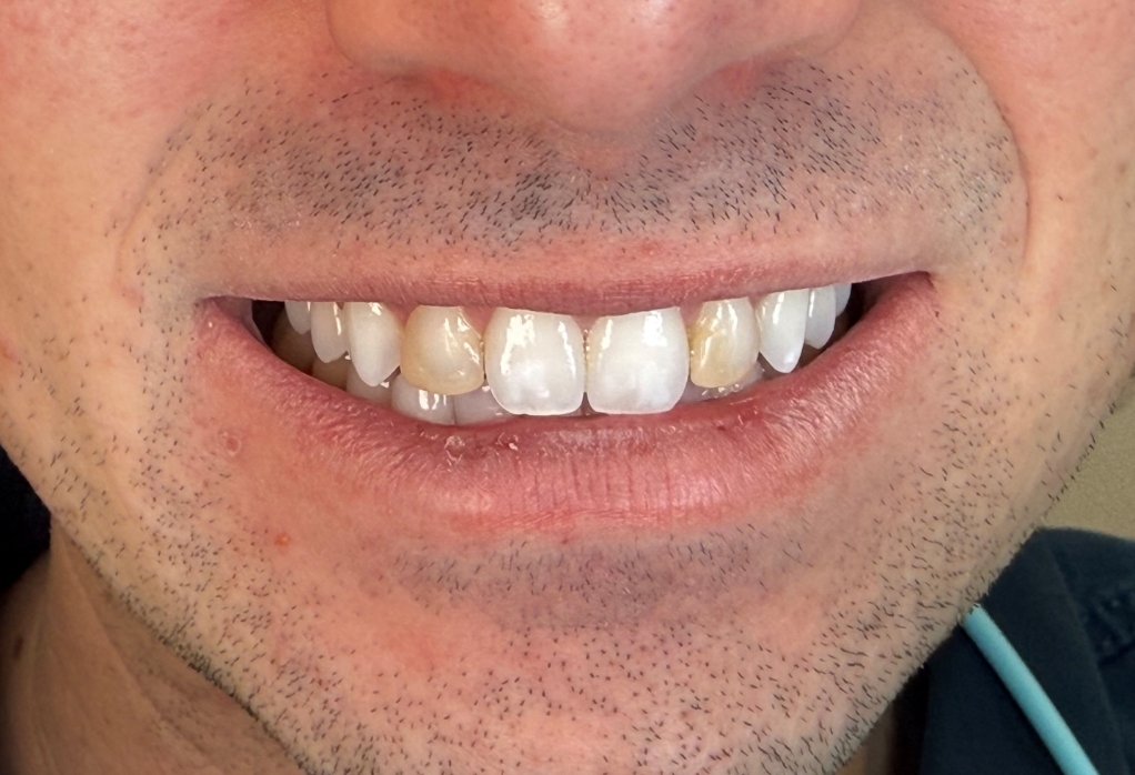 Smile with two yellowed teeth in the upper arch