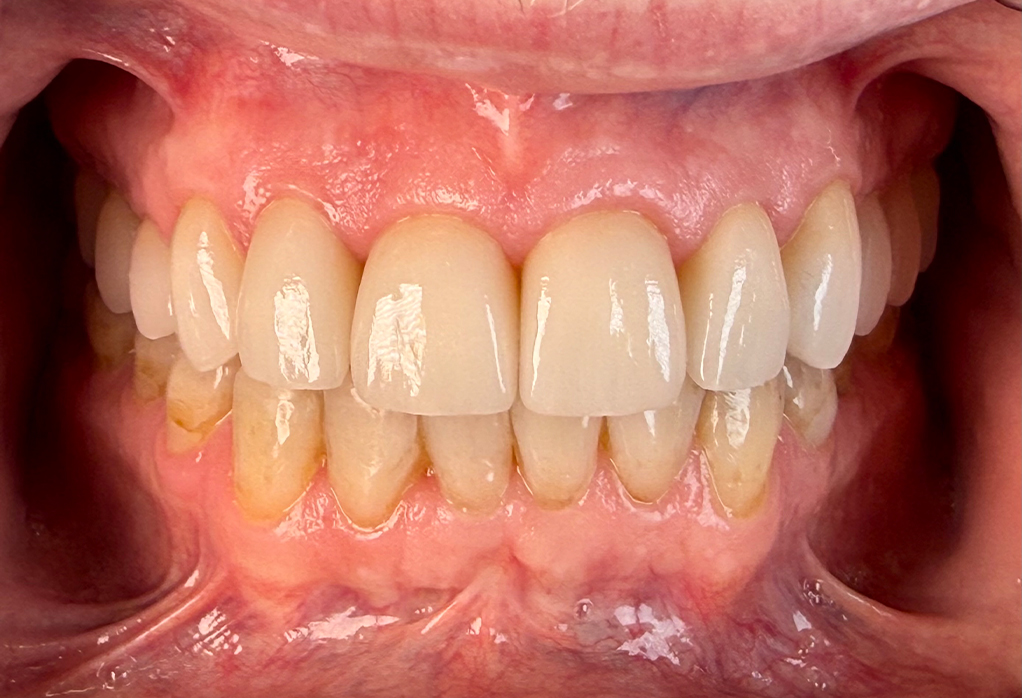 Close up of smile after dental care has been performed