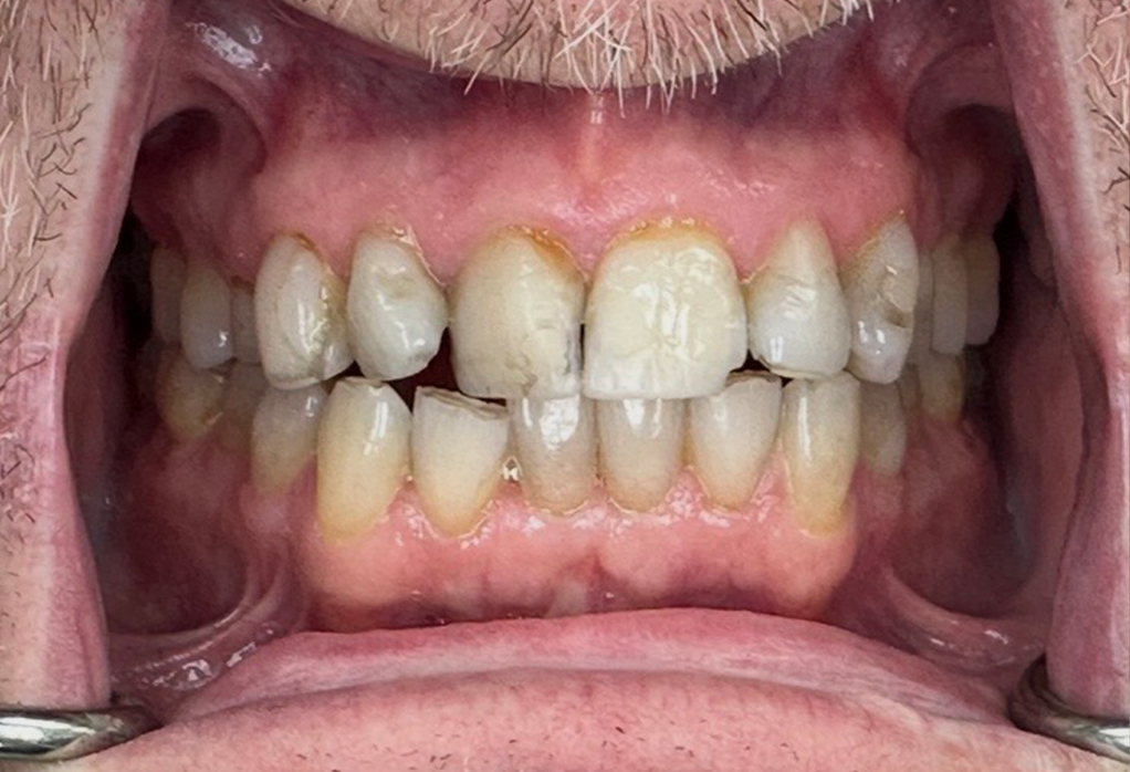 Close up of darkened smile