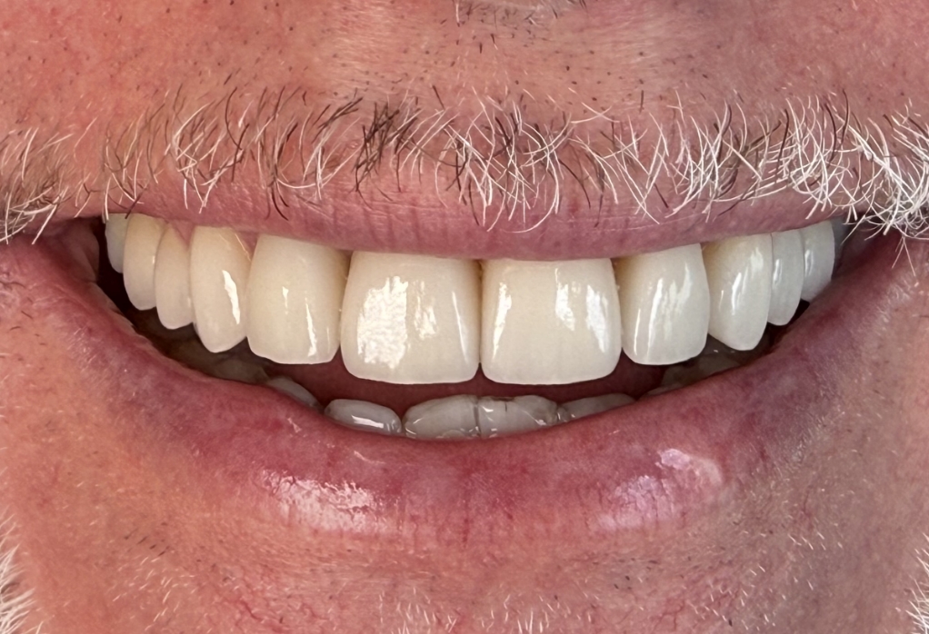 Smile with whiter repaired teeth