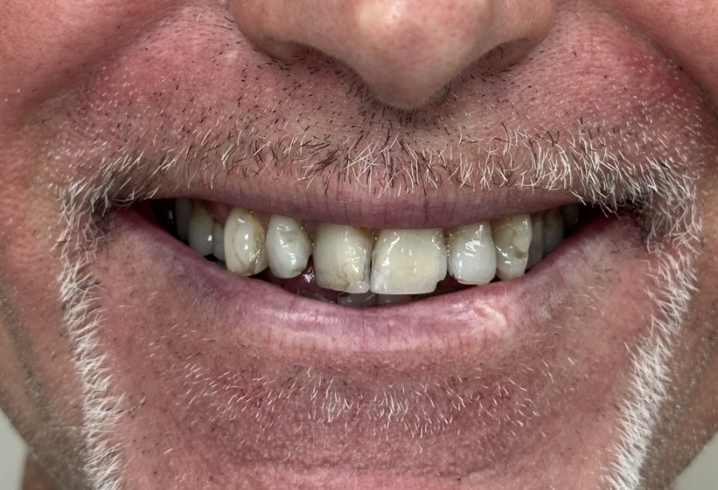 Smile with multiple darkened and chipped teeth