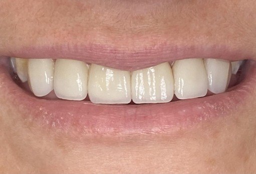 Close up of smile after correcting stained teeth