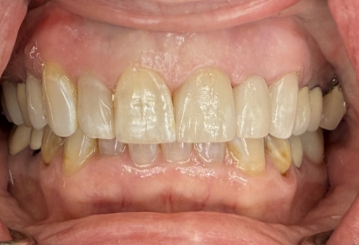 Close up of smile after correcting stained teeth