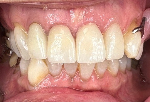 Close up of smile after teeth whitening