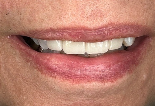 Close up of person smiling after fixing discolored and chipped teeth