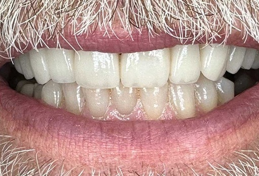 Close up of man with whiter teeth and more even gumline