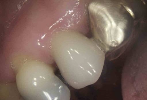 Close up of teeth with white crowns and fillings