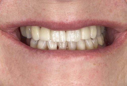 Close up of person smiling after correcting tooth stains