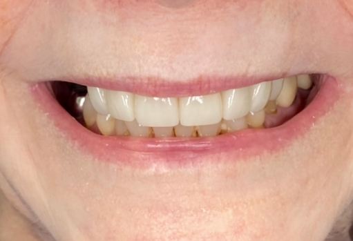 Close up of smile with brighter and more aligned teeth
